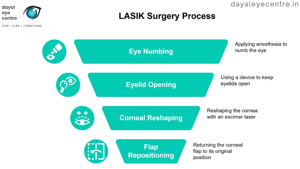 Lasik surgery process