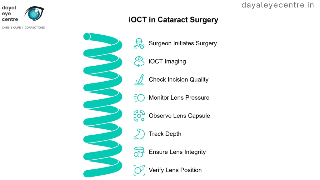 IOCT in cataract surgry
