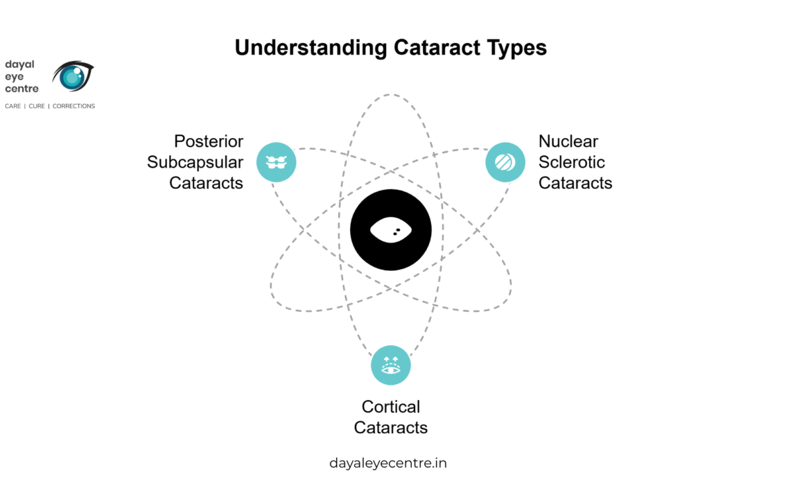 Types of Cataracts