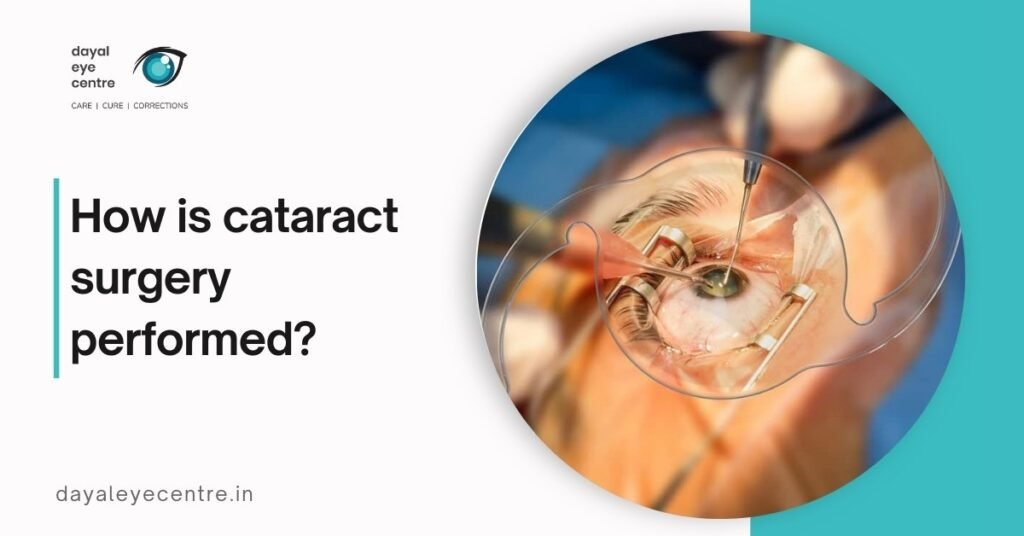 How Is Cataract Surgery Performed? Step-by-Step Procedure Explained