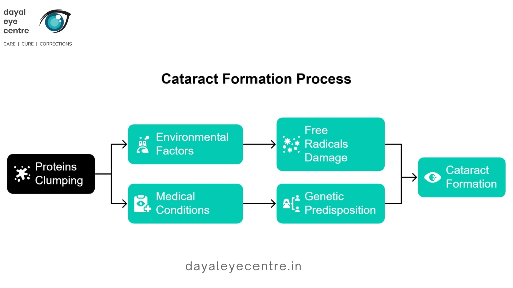 cataract formation process