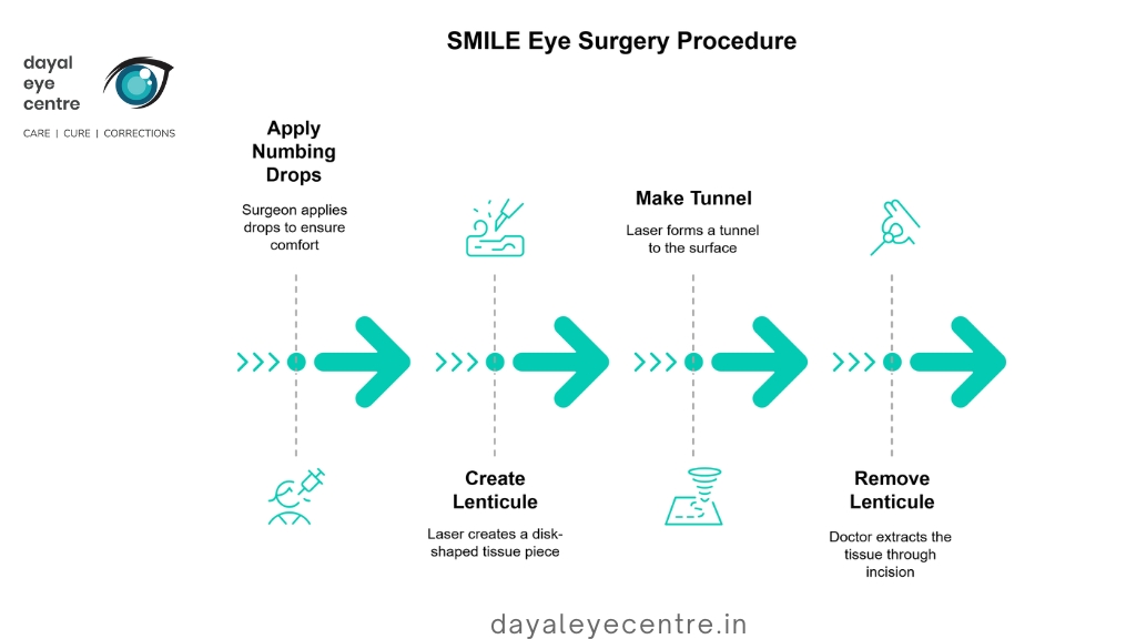 SMILE eye surgery procedure