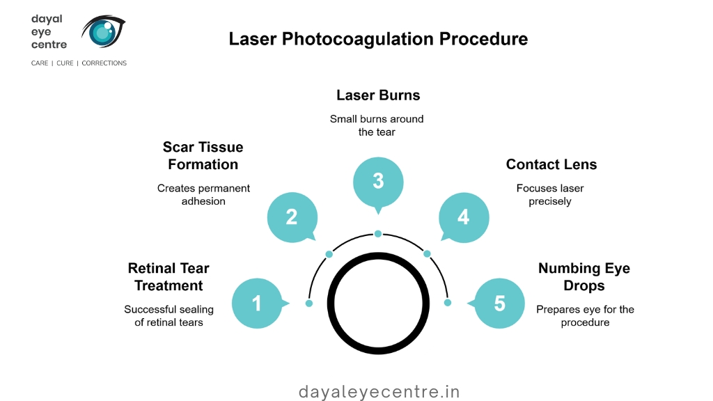 Laser photocoagulation procedure
