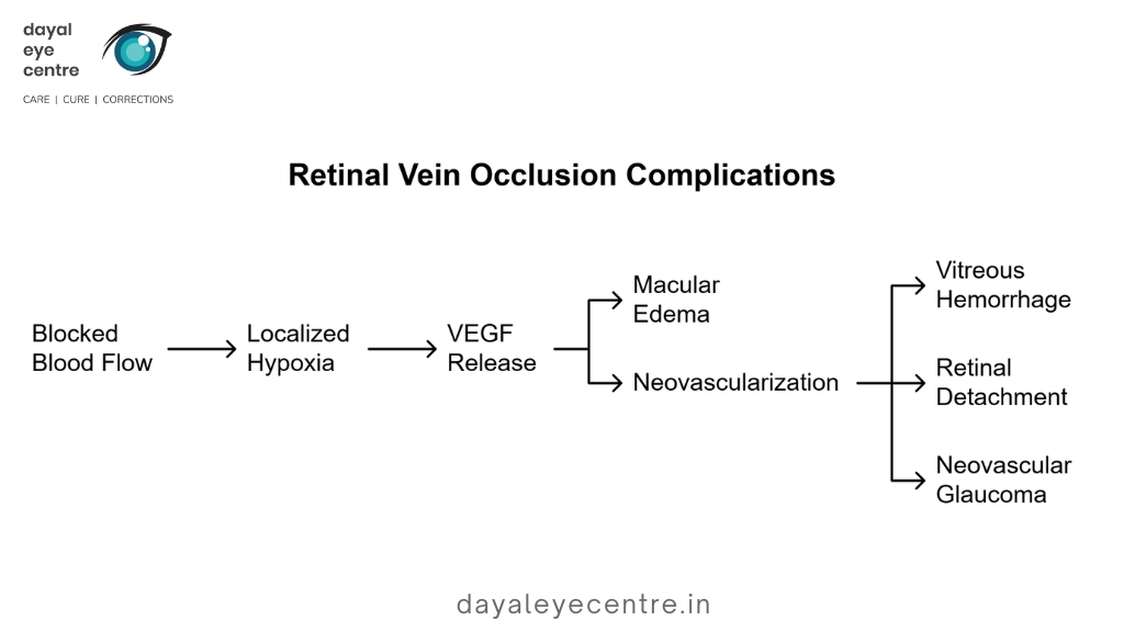 Retinal vein occlusion complications