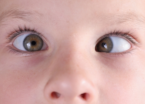 Squint- Eye Correction