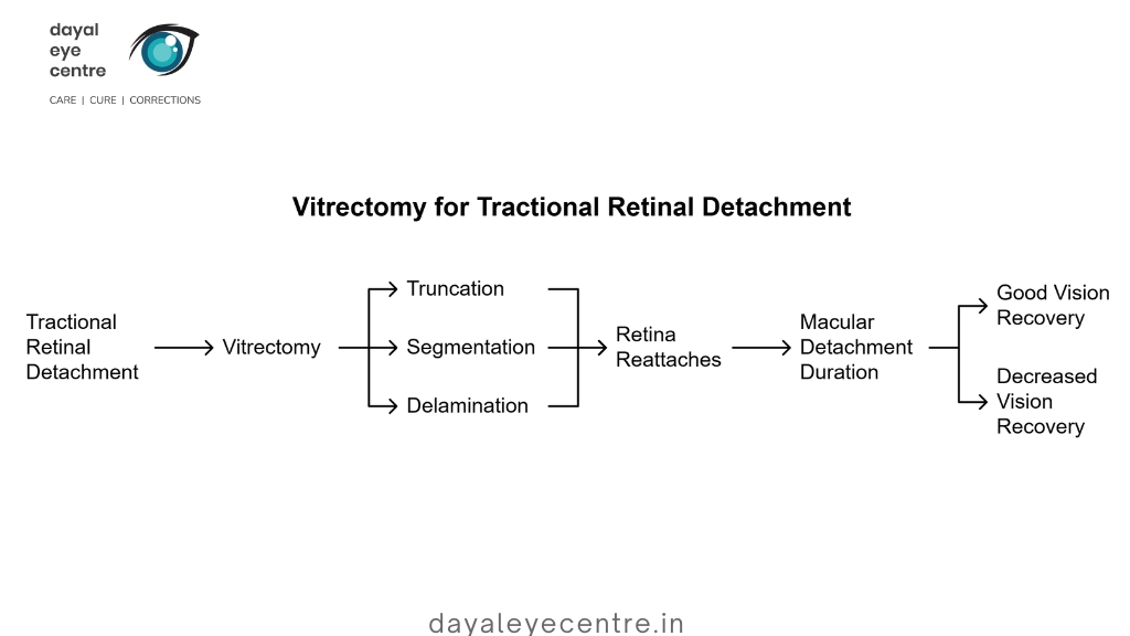 Vitrectomy for tractional retinal detachment
