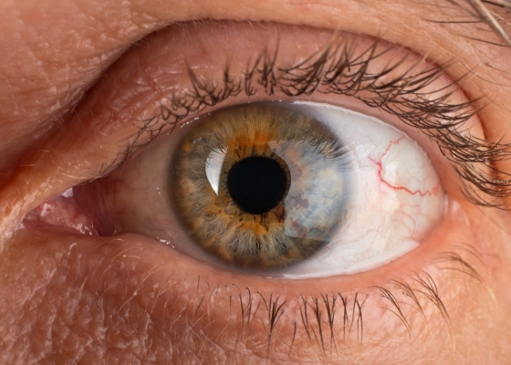 corneal treatment