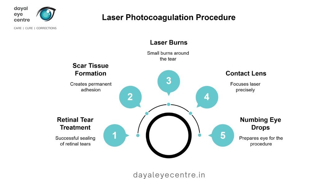 Laser photocoagulation procedure