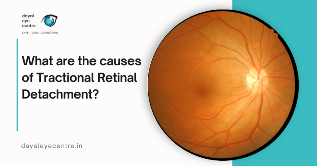What are the causes of Tractional Retinal Detachment?