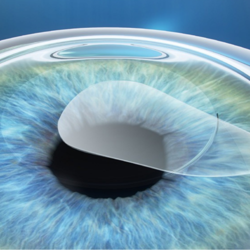 ZEISS VisuMax SMILE in our operating theatre