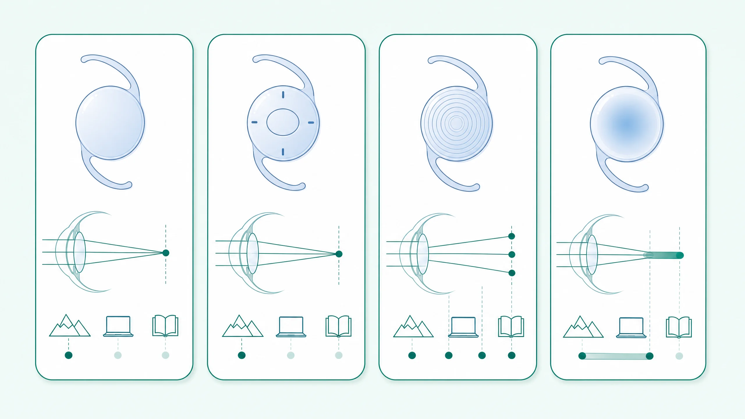 Diagram of four intraocular lens types and their focus ranges