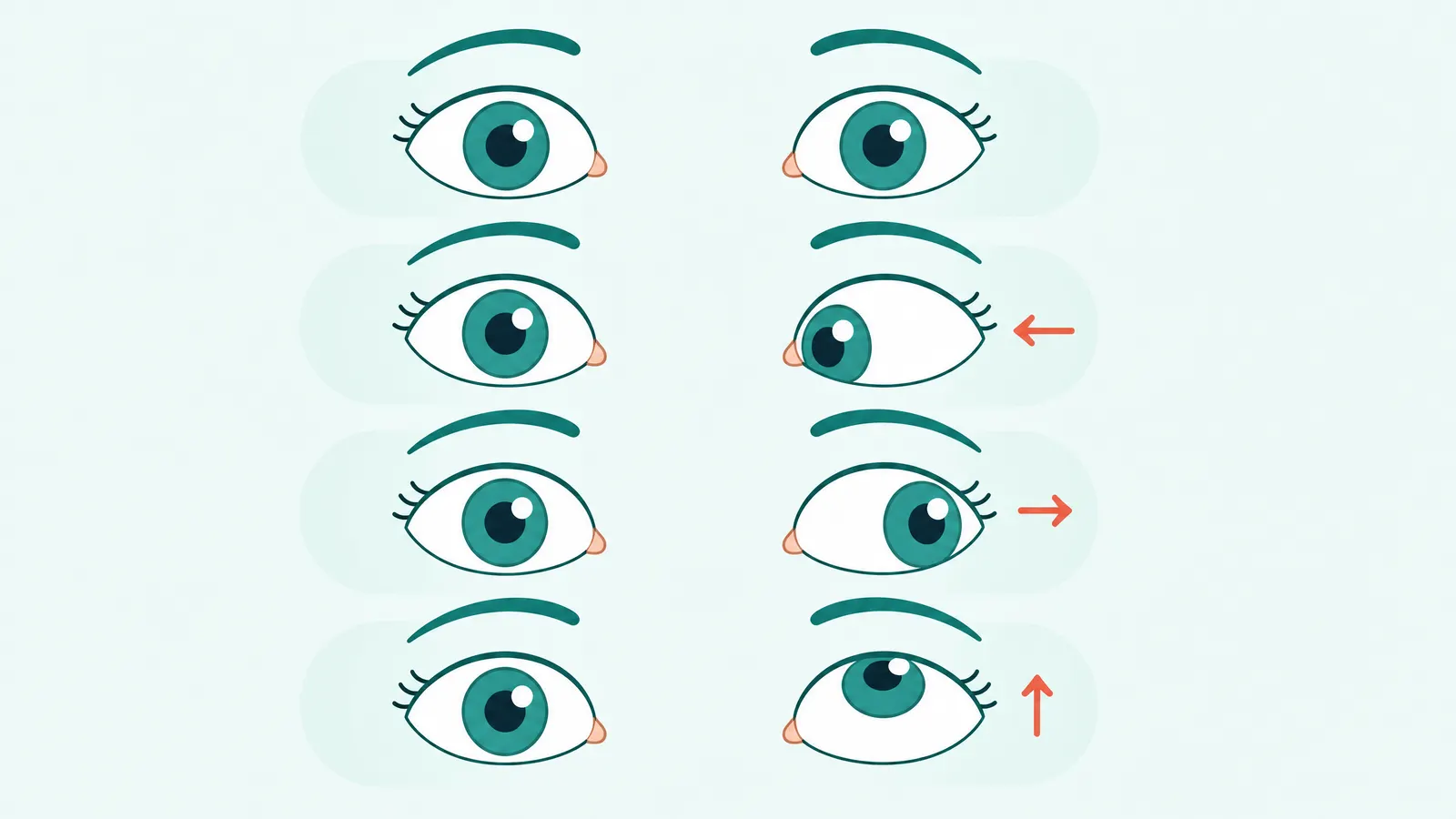 Diagram of different types of eye misalignment (squint)